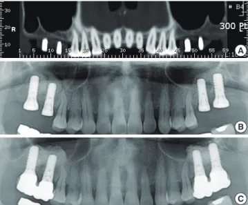 Figure 9. (A) Extremely resorbed and pneumatized posterior maxil- maxil-la. Note that 1-2 mm of alveolar bone height remained