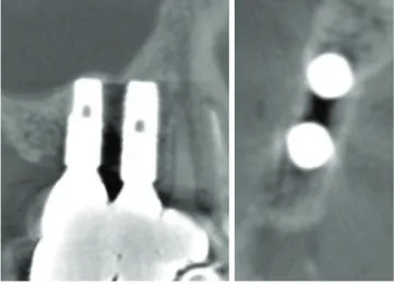 Figure 1. Pre-operative panoramic radiograph. Figure 2. Bone resorption is prominent between #15i and #16i with  internal scattered residual bony fragments