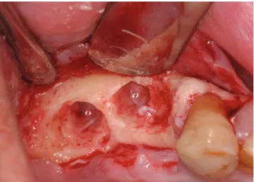 Figure 4. Fixture threads are exposed on the buccal and interproxi- interproxi-mal area