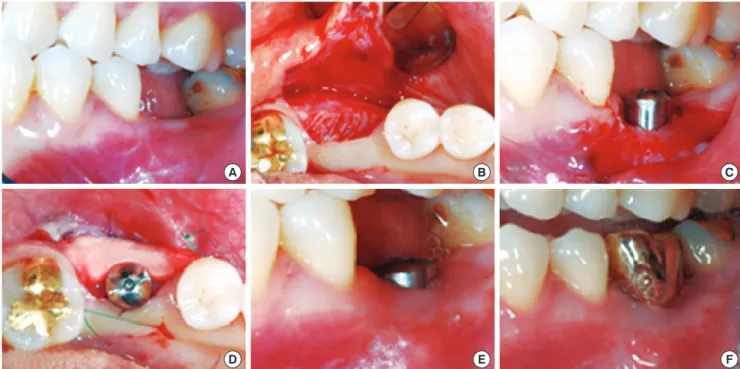 Table 1. Dimensional change of keratinized gingiva before and after  surgery.