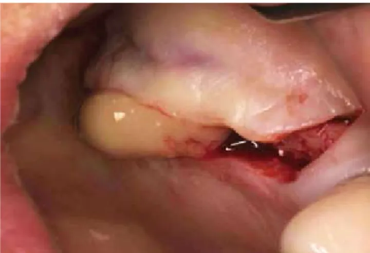 Figure 1.  Postoperative infection following sinus augmentation. Figure 2.  The discharge of pus and graft materials after the inci- inci-sion.
