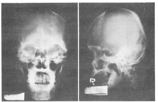 Fig. 2.  Lt.  common  carotid  angiogram: 