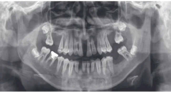 Figure 9.  RInitial radiographs of case 2 pateint. Note the discrete  vertical bone defects and missing teeth.