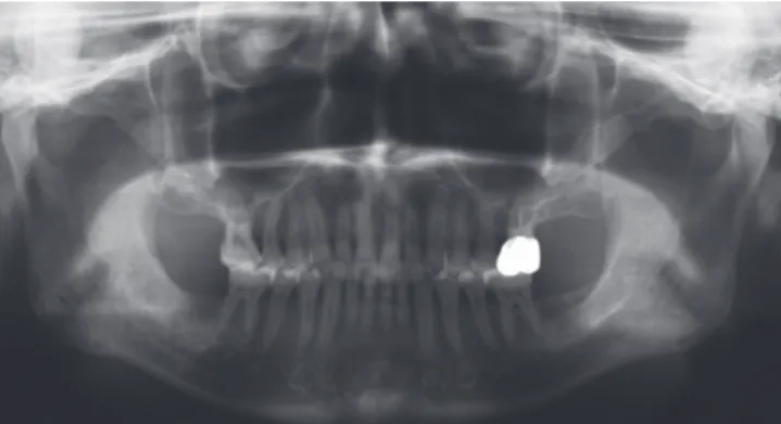 Figure 2.  After extraction of #16, marked alveolar bone resorption  and pneumatization of the maxillary sinus is visible.