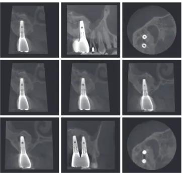 Figure 8.  Final prosthetic loading was initiated 13 months after the  first implant surgery.