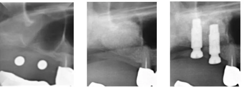 Figure 2. X-rays of implants placed by sinus floor elevation(lateral approach-staged)：x -50 of sectioned view from pan- pan-oramic X-ray.