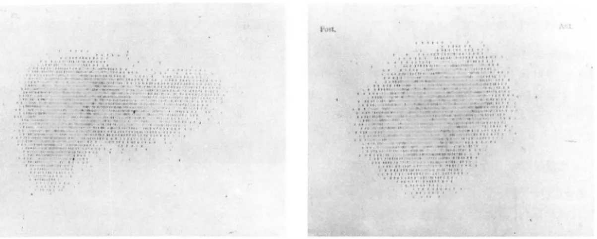 Fig.  2.  Typical GB  indentation  in  AP  and lateral  pro jection  proven GB  Empyema  in  Scintiscan  of  liver  R t:  AP  Lt:  lateral 
