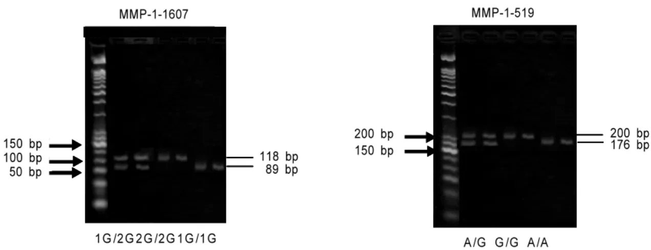 Figure 2. SNPs at MMP-1-1607 and MMP-1-519 after restriction enzyme digestion were electrophoresed in 3% agarose gel  and stained with 0.1% ethidium bromide
