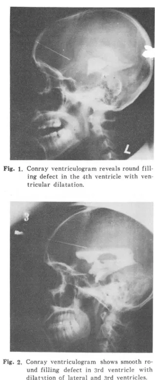 Fig.  1.  Conray  vent ricul ogram  reveals  round  fill - -ing  defect  in  the  4t h  ve ntricle  w ith   ven-tricular  dila ta tion