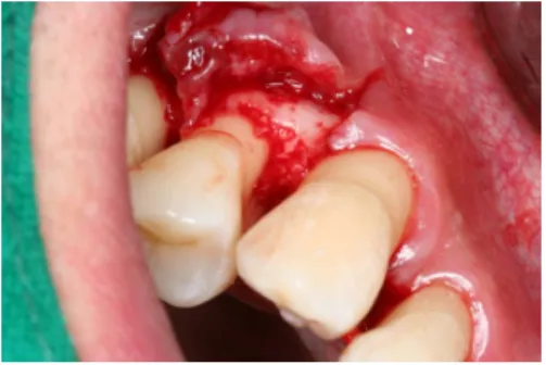 Figure 1. Preoperative periapical view Figure 2. Flap elevation Figure 3. Bovine bone material(BBP Ⓡ ) grafting