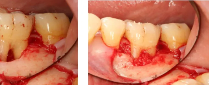 Figure 25. Suture    Figure 26. Radiographic comparison between initial and 6month later