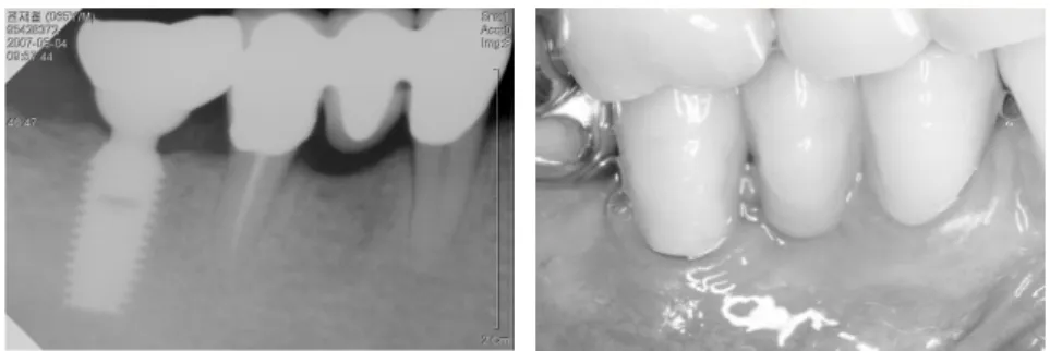 Table 1. Preoperative and postoperative probing depth change(mm)
