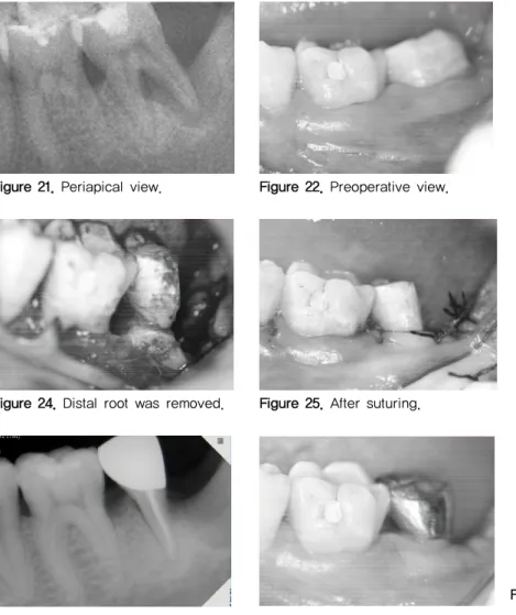 Figure 21. Periapical view. Figure 22. Preoperative view. Figure 23. After flap reflection.
