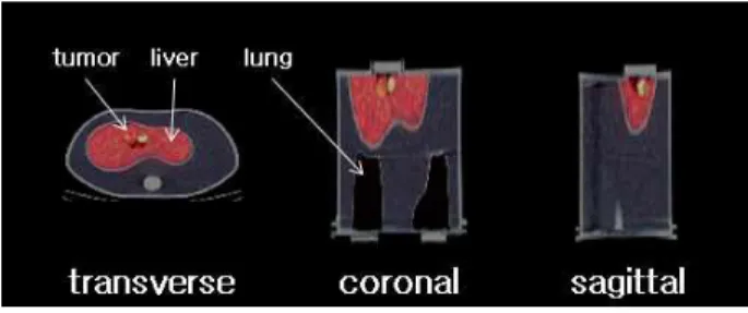 Fig.  2.  Cu-64  PET/CT  torso  phantom  imaging  with  tumor  region.  Torso  phantom  was  consisted  by  lung,  liver  and 