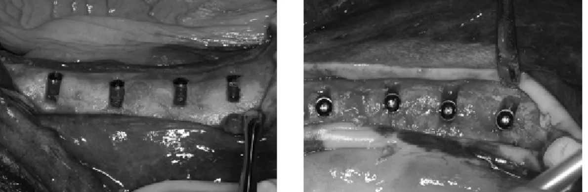 Figure 1. Bone dehiscence defect preparation on implant buccal aspect.