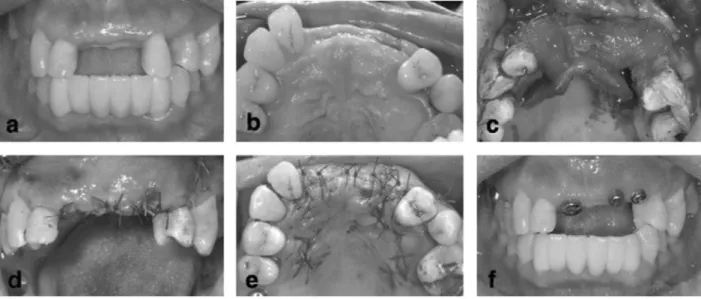 Figure 2. Intraoral clinical view of Second patient. (a) Vertical clincal pre operative view