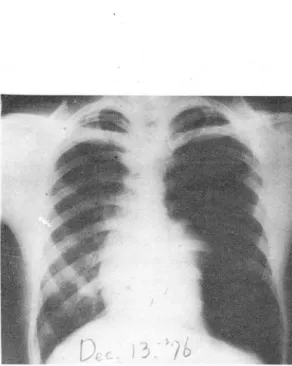 Fig.  III  . .  The  follow-up  P-A  view  of  Lhe  c hest. 