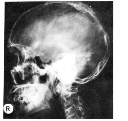 Fig.  1.  Parietal  Meningioma.  Lateral  view of  the  skull  shows  moderate  irregular  hyperostosis  below  the  inner  table  and  slight  perpendicular  spiculation  and  thickening  of  the  outer 