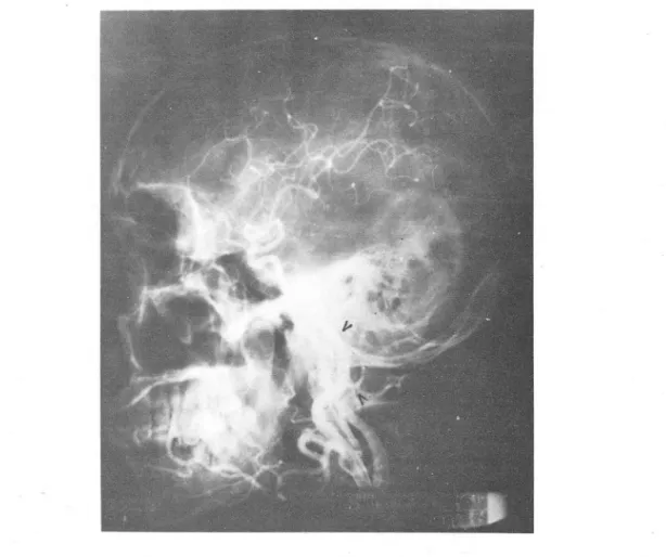 Fig.  3.  Following  indivisual  superselective  embolization  with  Gelfoam ,  selective  right  external  c arotid  arteriogram showing successful artificial  oc c1 usions  (<)  of  the  right 