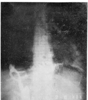 Fig.  2.  Inferior  vena  cavogra phy.  Markedly  tor. 