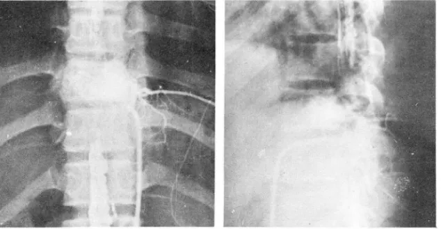 Fig.  9.  Extradural  arteriovenous  malformation ,  T9 