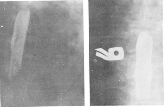 Fig.  2.  Extradural  me tastatic  Ca. ,  T5 -8 