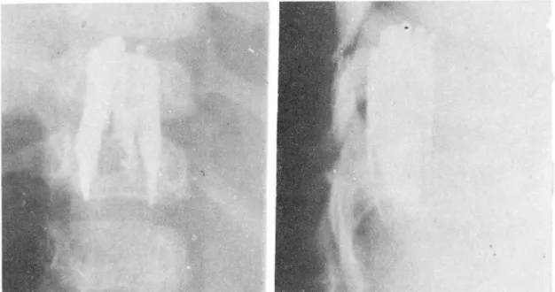 Fig.  4.  Extradural  neuroblastoma ,  T12  .. Ll 