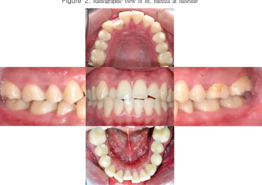 Figure  3.  Clinical view at baseline: generalized gingival inflammation and redness and swelling of interdental papillae were seen