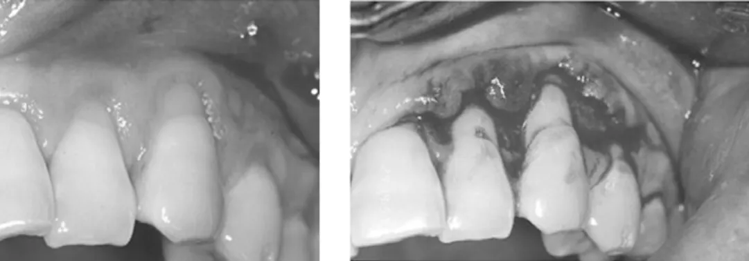 Figure  1.  Preoperative view Figure  2.  Flap Reflection with partial thicknessNelson이  이식술과  유경피판술을  결합한  방법을  소개하였으며, 1992년 Harris는 양측치관유두판막술로 이식편을  덮는  술식을,  그리고  1994년  Bruno는  수직절개  없는  상피하  결합조직  이식술을  소개하였다17-20)