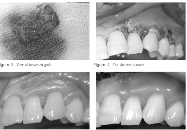 Figure  3.  View of harvested graft Figure  4.  The site was sutured. 