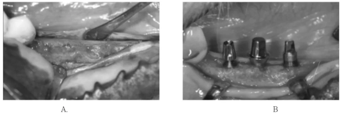 Figure  2.  Clinical  photos  of  implant  installation  surgery.  A,  After  flap  reflection