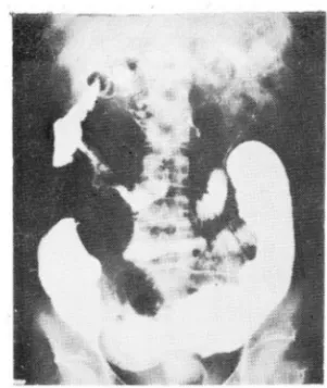 Fig.  7 .  Crohn ’ s  ûi sease:  Mult iple  ex t rinsic  rna ss  effects  in  t h e  te rrn inal  ileurn 