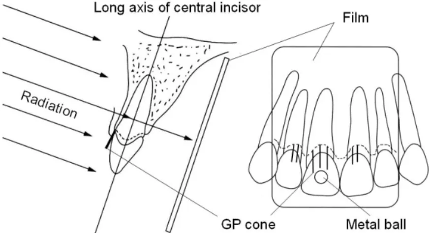 Figure  1.  Schematic  of  taking  radiograph 