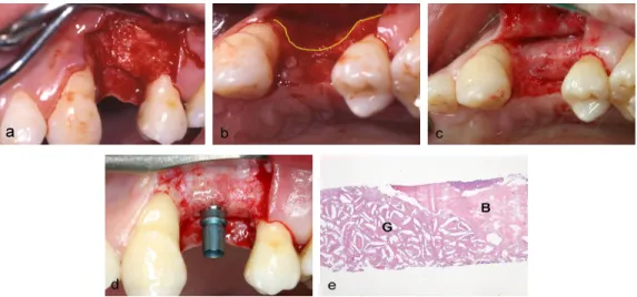 Figure  1.  Case  1.  (a)  Buccal  view  of  horizontal  ridge  deficiency  of  maxillary  left  first  premolar