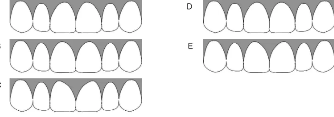Figure  3.  Gingival  margin  shape  of  the  central  incisor  -1/9  horizontal  component  of  the  crown  width