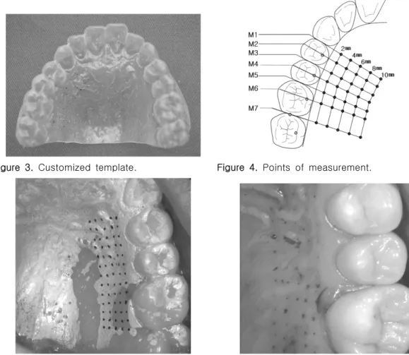 Figure  5.  Customized  template  was  placed  in  oral  cavity(left),  points  of  measurement(right).