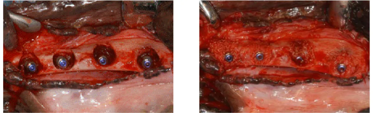 Figure  3.  (Left)  Four  identical  3.5mm-diameter  titanium  implants  with  15mm  length  were  placed  into  the  defect  sites