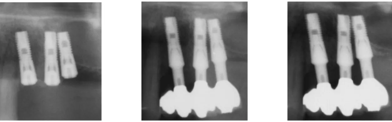 Table 5. Frequency distribution of the amount of bone resorption during the 1 or 2-year observation period with respect to design of the ISPs and jawbone shape (C3, C4, and B3) - bone quality and quantity.