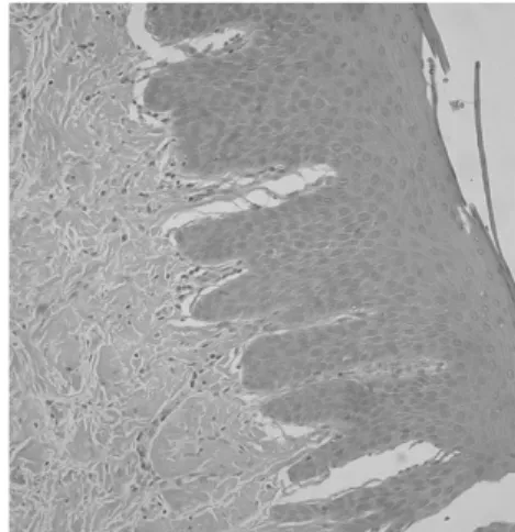 Figure 1. Gingival inflammation classified as mild, ac- cording to inflammatory cell infilitration.