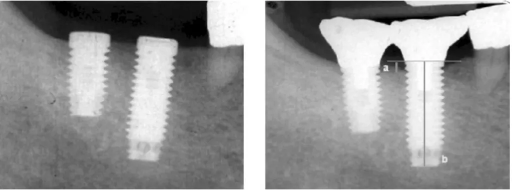 Figure 1. Bone height measurement.