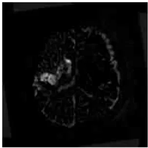 그림 3. 우측 뇌영상과 좌측 뇌영상의 차분에 의한 병변 강조 영상 Fig 3. Emphasize the pathological pattern of the brain image by the difference between the right and left