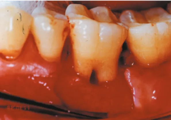 Figure 6. Class  II  furcation  defect  following  defect debridement.