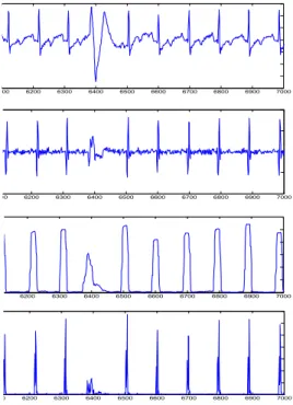 Fig 3. Extraction of R-peak by Moving Average Filter with a size=0.12sec