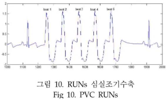 Fig 9. Acquisition of Abnormal Heart Beat Data Generated by Patient Simulator