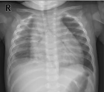 Figure 1.  Frontal view of the chest radiograph shows car- car-diomegaly and pleural effusion at right thorax