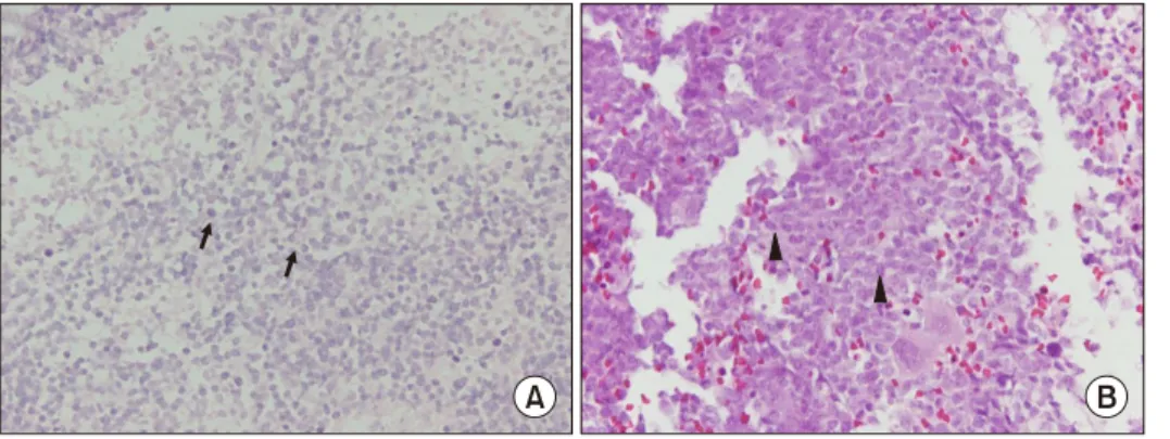 Figure 2. Bone biopsy of right  distal clavicle revealed increased atypical cell infiltration with  ne-crosis, which was consistent  with leukemic infiltration (A,  H&amp;E stain, ×400, arrows)