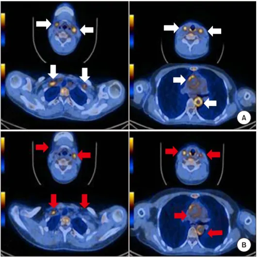 Figure 4. Positron emission to- to-mography/computed tomography (PET/CT) images of patient with  Takayasu’s arteritis (axial view).