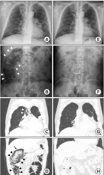 Figure 1. Plain radiographs and computed tomography (CT)  scans at the time of pneumatosis intestinalis and follow-up  af-ter 4 weeks from the onset