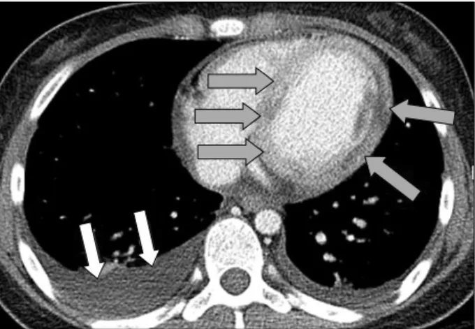 Figure 4. Contrast enhanced computed tomography of chest. 