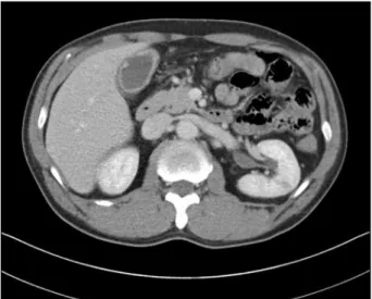 Figure 1. Abdominal and pelvic computed tomography scan  showing diffuse wall thickening of the gallbladder with some  irregularity.